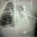 FetalTherapy_Vignery3