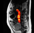 OHSU Placenta Research - Placenta MRI
