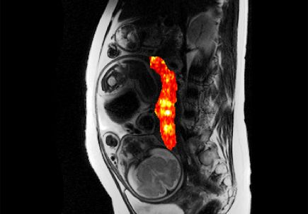 OHSU Placenta Research - Placenta MRI
