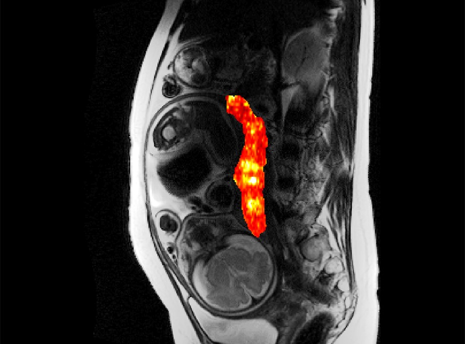 MRI of placenta and baby with the placenta highlighted in red.
