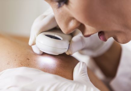Melanoma study