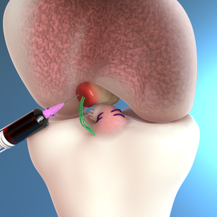 BEAR technique for ACL repair