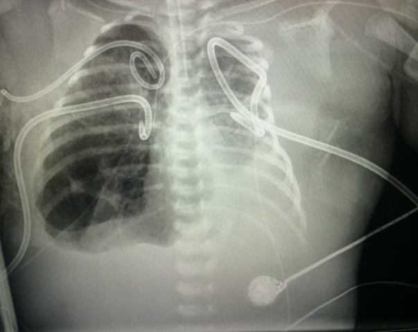 Fetal Therapy