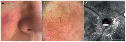 Encontrar melanoma