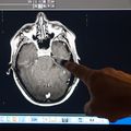 Paciente de OHSU es el primer caso documentado del mundo de trastorno cerebral por inhalación de fentanilo