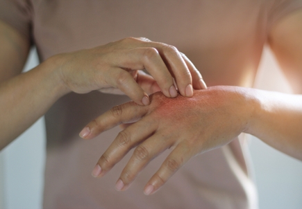 eczema