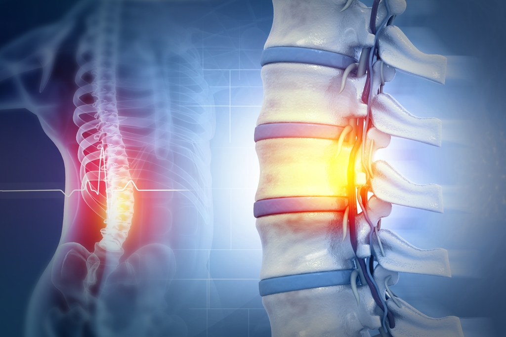 La imagen es una imagen generada por computadora de una columna esquelética con un área de dolor resaltada en varios colores sobre un fondo azul.