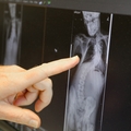 Spine conditions and complex care 