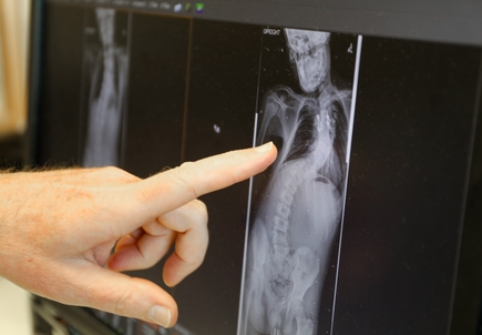 Spine conditions and complex care 