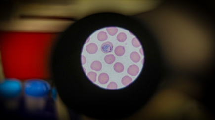 A malaria parasite infects a red blood cell under a microscope. OHSU researcher Brandon Wilder, Ph.D., is working to develop a vaccine to prevent malaria infection. (OHSU/Christine Torres Hicks) Several pink circles with one having purple dots, in view through a microscope lens.