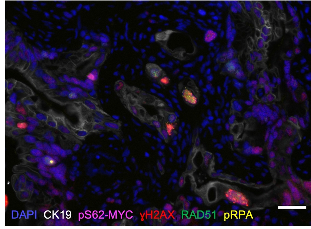 inmunofluorescencia cíclica de un tumor de adenocarcinoma ductal pancreático