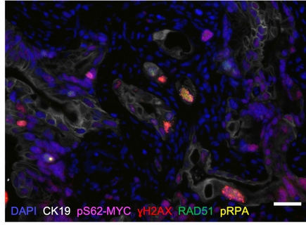 inmunofluorescencia cíclica de un tumor de adenocarcinoma ductal pancreático