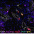 inmunofluorescencia cíclica de un tumor de adenocarcinoma ductal pancreático