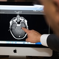 Causes of traumatic brain injury vary widely worldwide, study finds