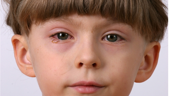 5 things to do when your child gets pink eye