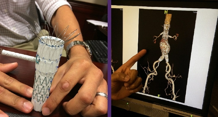 Repair of complex aneurysms has patients home in a day