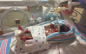 Birdie stayed in the NICU for more than three months