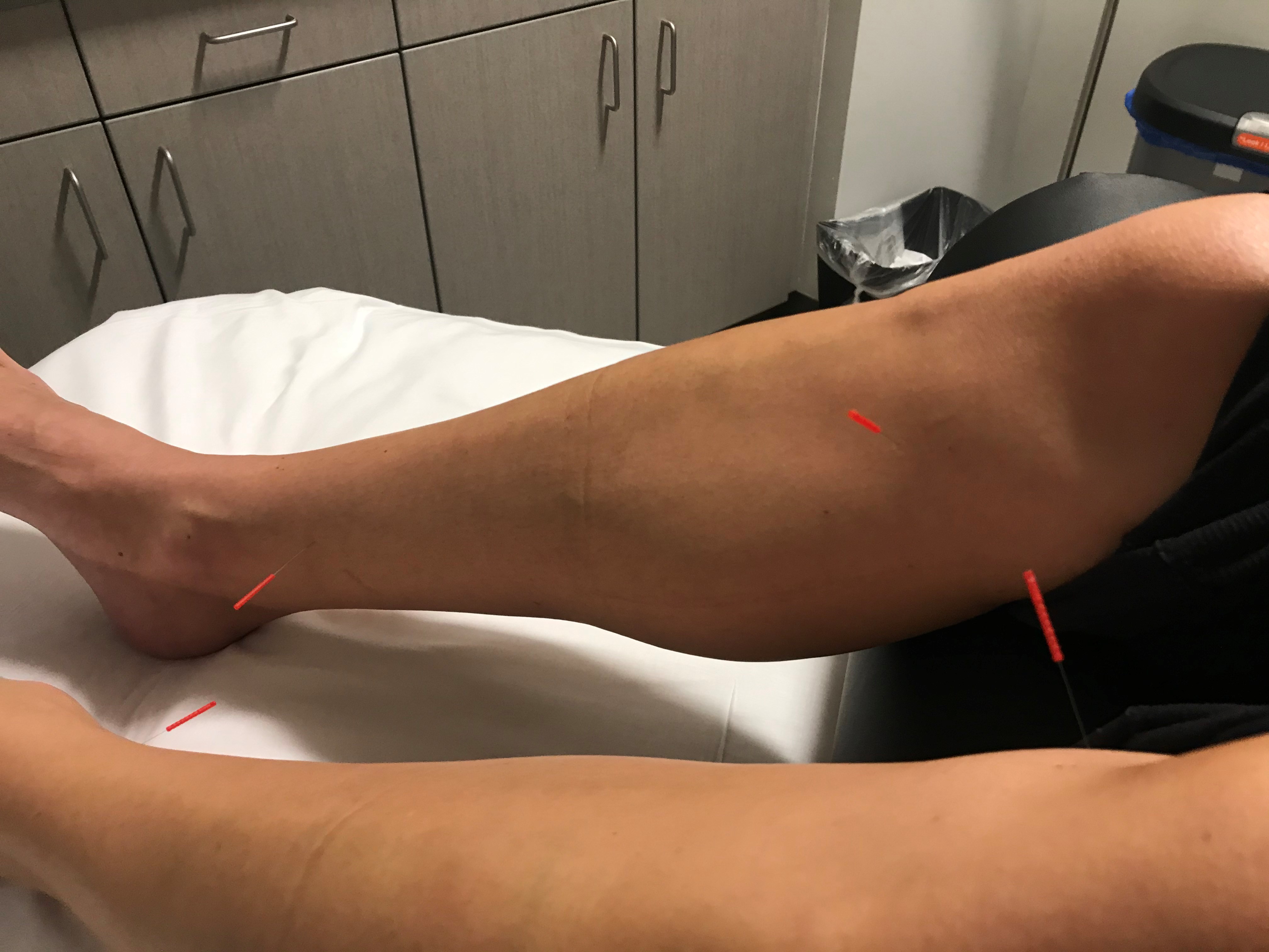 gina gets acupuncture