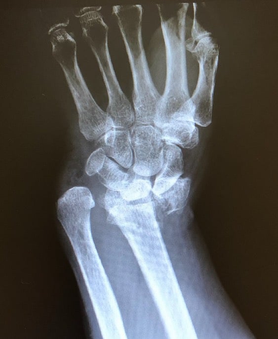 wrist broken xray