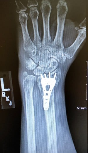 wrist fixed xray