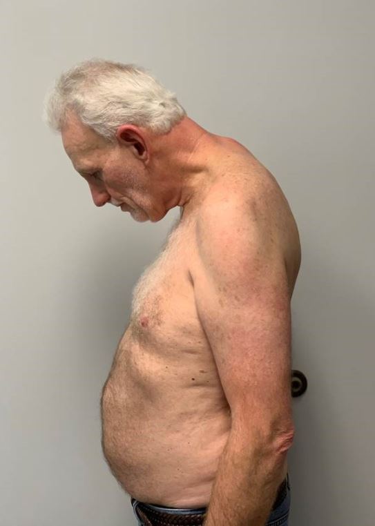 Dean Spicer prior to his neck reconstruction.