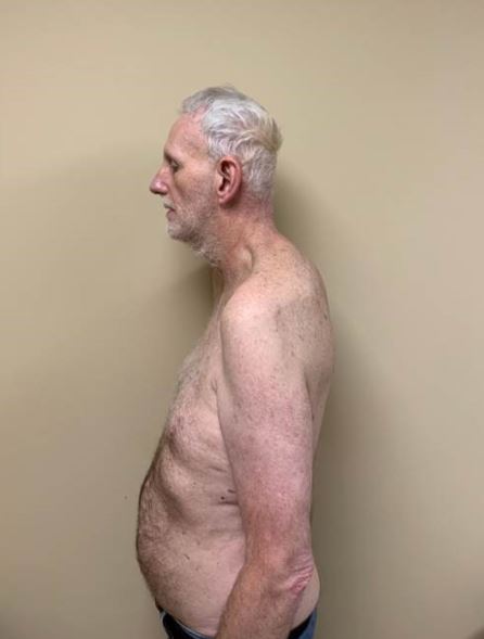 Dean Spicer after his neck reconstruction.