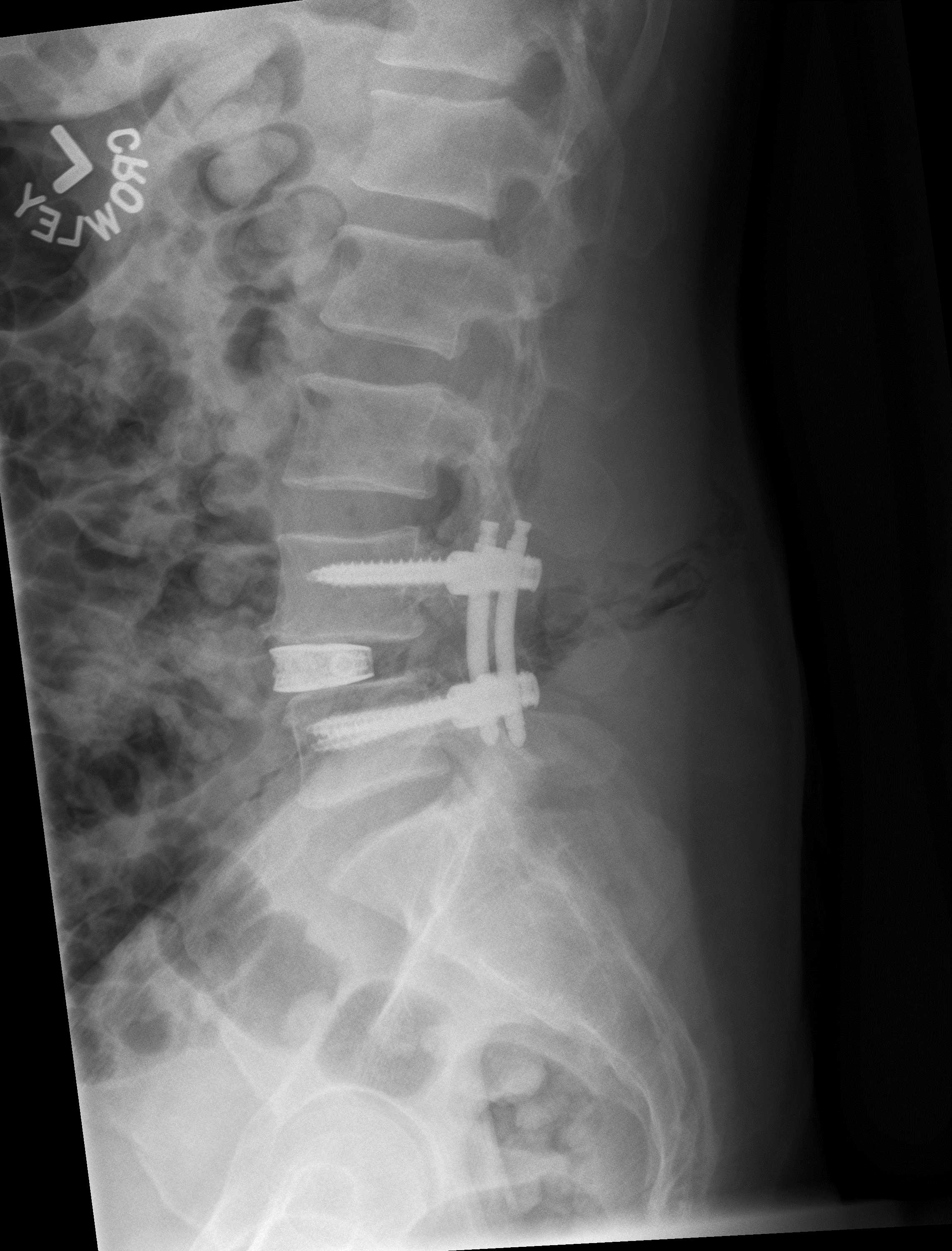 Alignment restored after surgery.