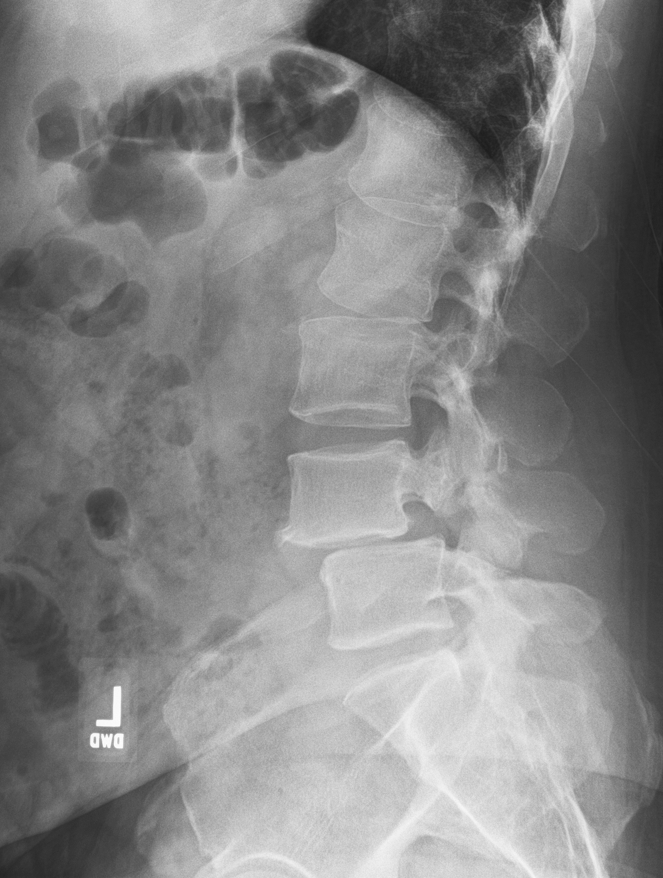 Slippage between L4 and L5 vertebrae