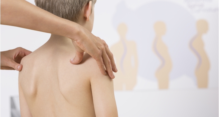 6 Things to know about the most common type of scoliosis