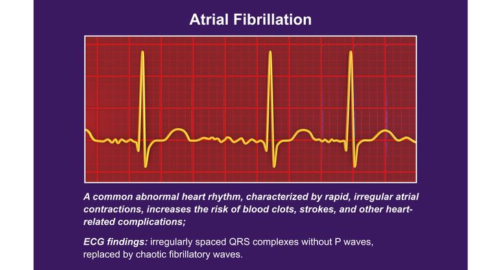 Pulsed-Field Ablation:A less risky approach to a healthier heartbeat
