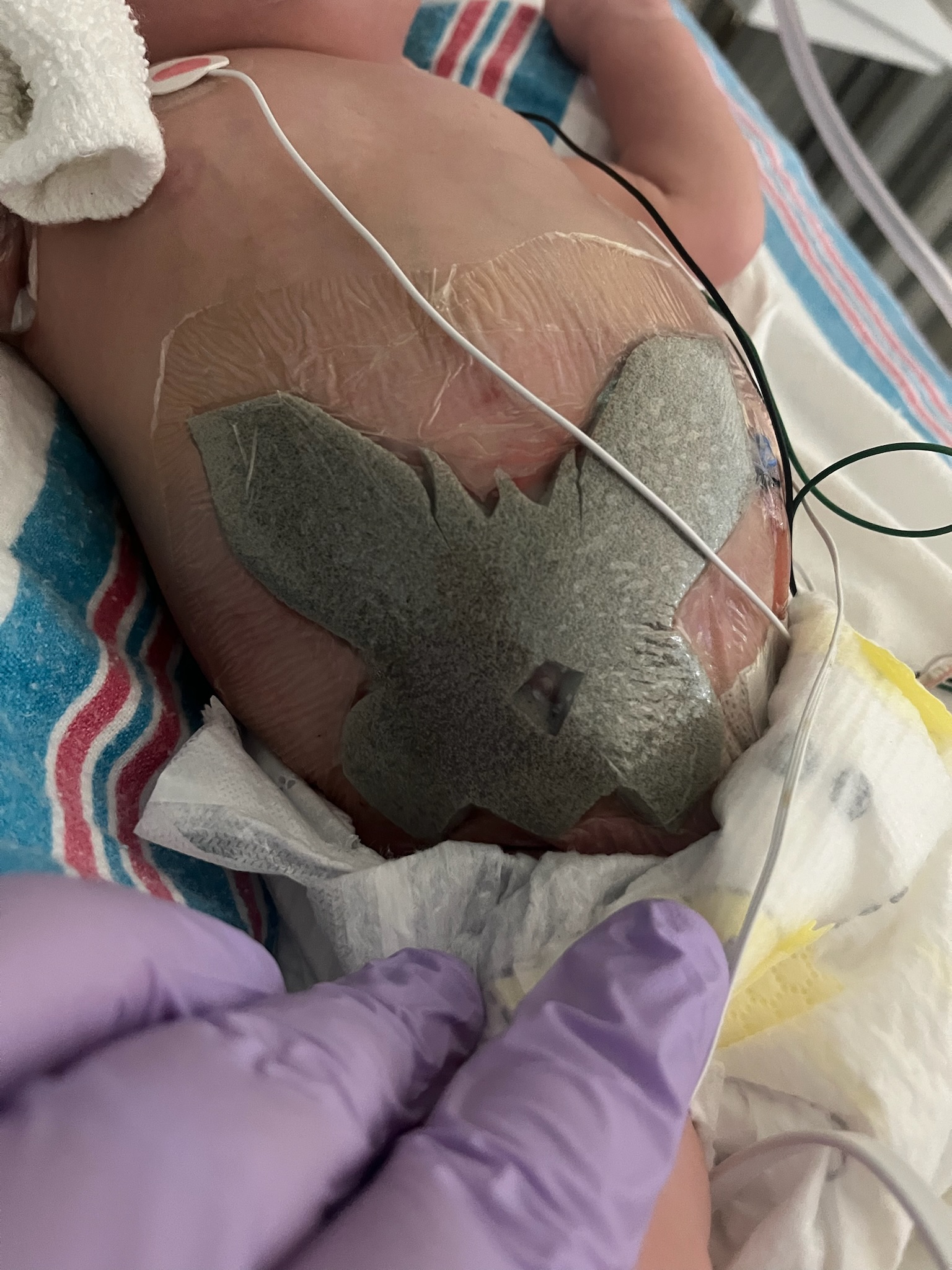 Trinity butterfly bandage 