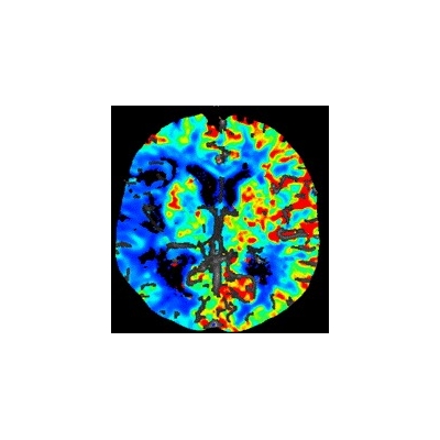 "Brain Attack" Gets Fast Tracked at Strong Memorial