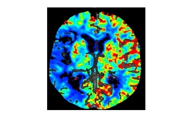 "Brain Attack" Gets Fast Tracked at Strong Memorial