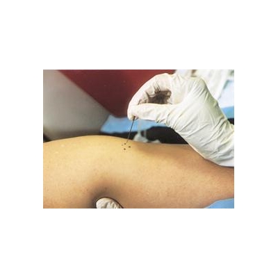 Some Eczema Sufferers More Prone to Smallpox and Other Viruses