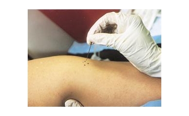 Some Eczema Sufferers More Prone to Smallpox and Other Viruses