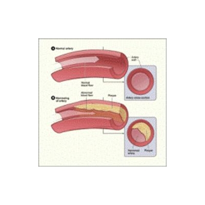 Enzyme Family Key to Future Treatments of High Cholesterol