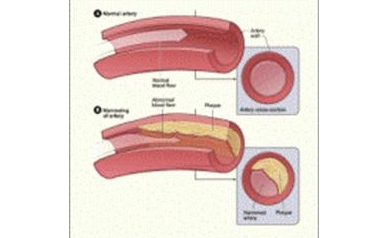 Enzyme Family Key to Future Treatments of High Cholesterol