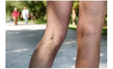 Varicose Veins: Why We Get Them and What Can Help