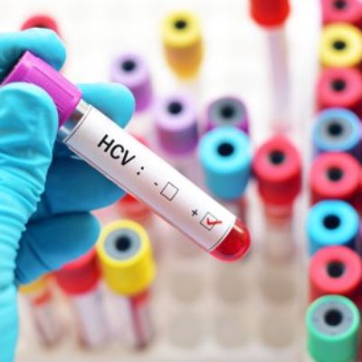 Hepatitis C: What You Need to Know