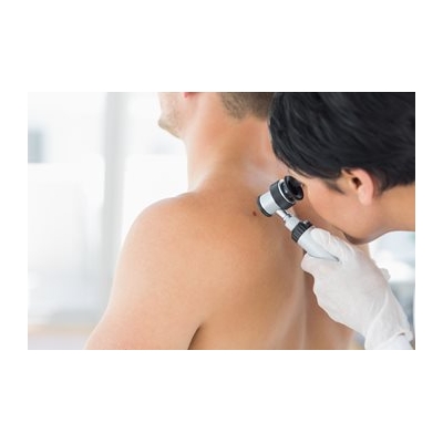 Skin Cancer Check: Know the ABCs