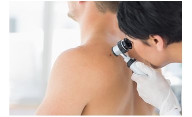 Skin Cancer Check: Know the ABCs
