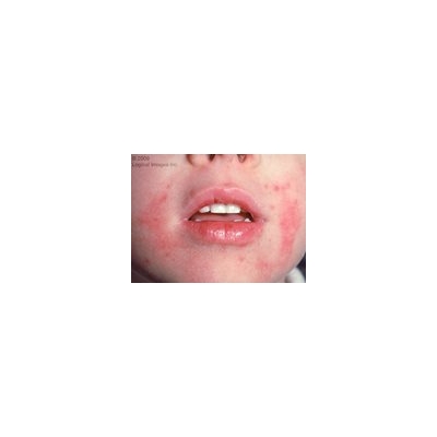 Exploring New Treatments for Eczema