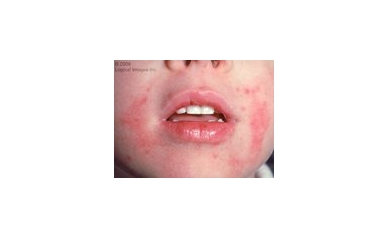 Exploring New Treatments for Eczema