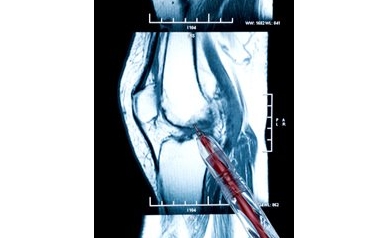 Pathologist Wins Breast Cancer Award to Study Bone Metastasis