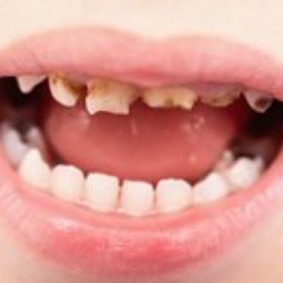 EIOH Awarded $3.5 Million to Study Role of Behavior and Stress in Children's Tooth Decay