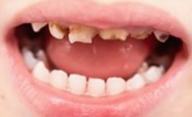 EIOH Awarded $3.5 Million to Study Role of Behavior and Stress in Children's Tooth Decay