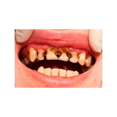 EIOH Scientist to Study Role of Yeast in Kids with Severe Tooth Decay