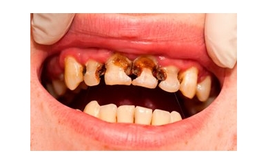 EIOH Scientist to Study Role of Yeast in Kids with Severe Tooth Decay