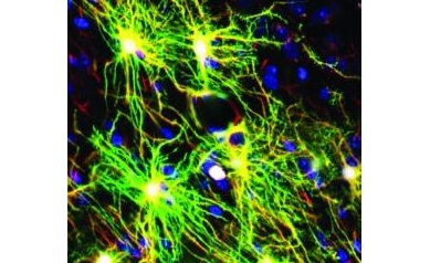 Brain’s Support Cells May Be Important Player in Schizophrenia