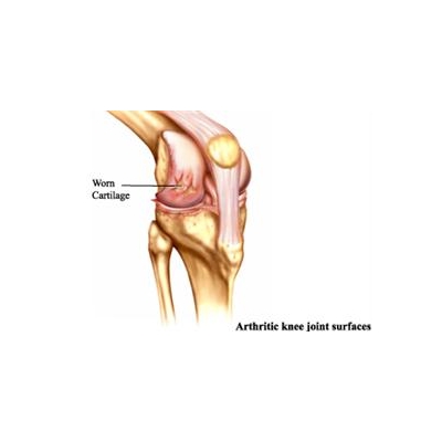 Hormone Promises to Keep Joint Injuries from Causing Long-term Osteoarthritis